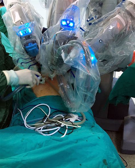 Xi Robotic Hernia Repair at Patricia Logan blog