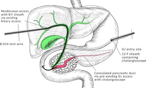 Bile Duct Stent