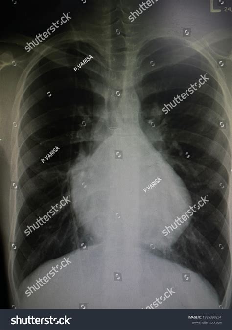 Boot Shape Heart Shape Tetralogy Fallot Stock Photo 1995398234 ...