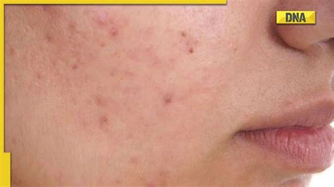 Image result for Exploding Pimples