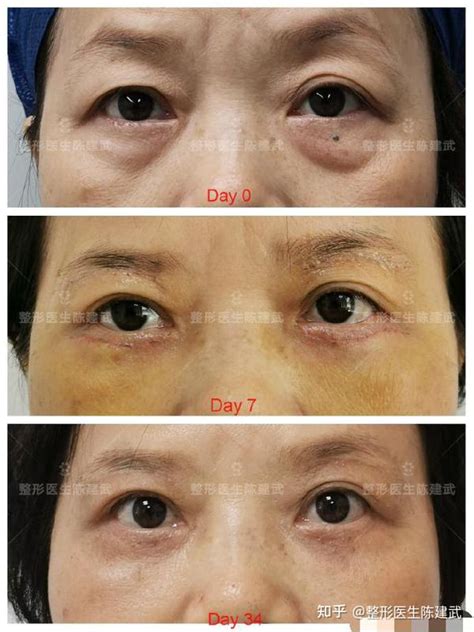 51岁女性外切眼袋+切提眉，手术一个月后，看起来年轻多了 - 知乎