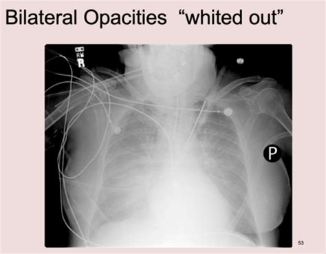Image result for Ali vs Ards PaO2/FiO2