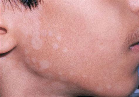 真菌感染皮肤病图片对照大全：种类及症状