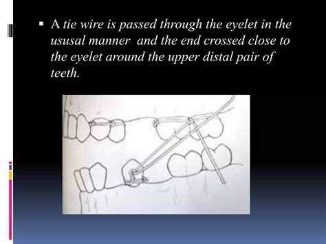 Image result for Intermaxillary Fixation