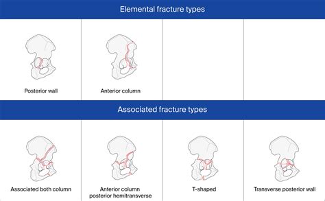 Types of acetabular fractures and their indications