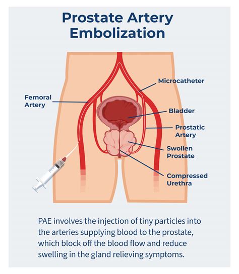Prostate Artery Embolization (PAE) Treatment | UVVC