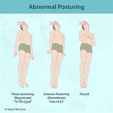 Abnormal Posturing NCLEX Guide: Decorticate vs. Decerebrate vs. Flaccid — King of the Curve