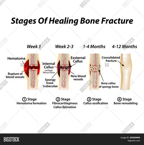 Ppt Bone Histology Fracture Healing Powerpoint
