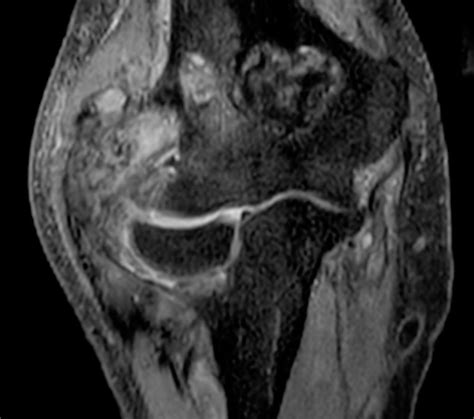 Sarkome: Erfolg versprechende Resultate - Onkologie - Universimed ...