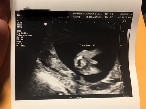13 Week Ultrasound Gender