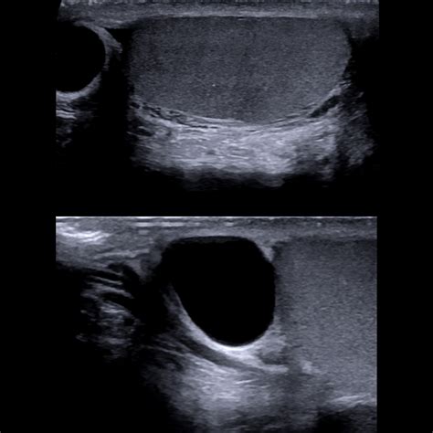 Epididymal Cyst Ultrasound