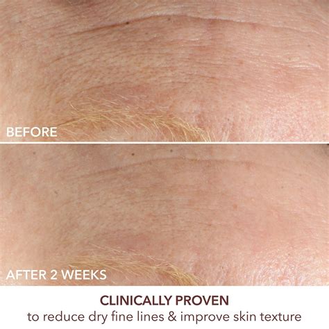 Tretinoin Cream Stretch Marks Before And After