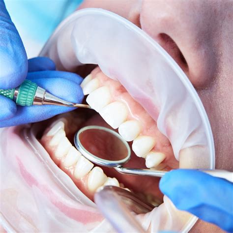 Disadvantages and Advantages of Deep Cleaning Teeth | Mohamed Seleem