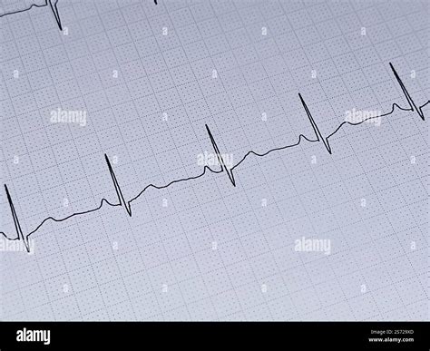 ECG ElectroCardioGraph paper that shows inferolateral T wave changes ...