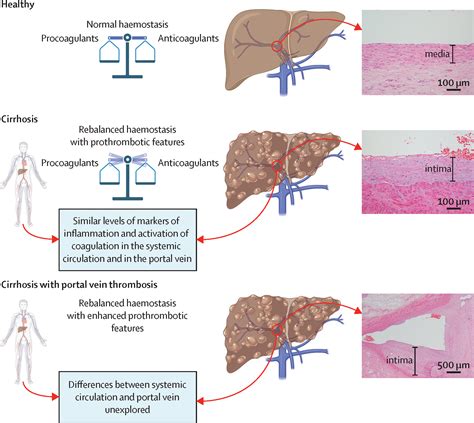 Portal Vein Thrombosis Non Malignant Portal Vein Thrombosis In Liver