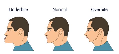 Overbite vs underbite - what's the difference?