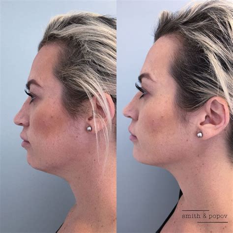 Kybella to contour Jaw line. | Facial aesthetics, Botox, Kybella