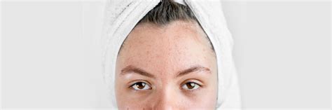 Hormonal Acne: The What, Why and the Remedy