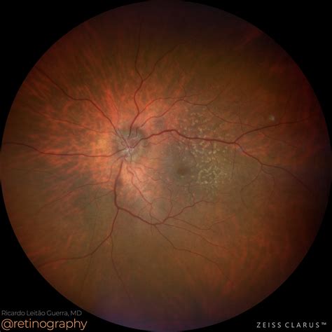 Optic disc drusen and Soft drusen – Retinography
