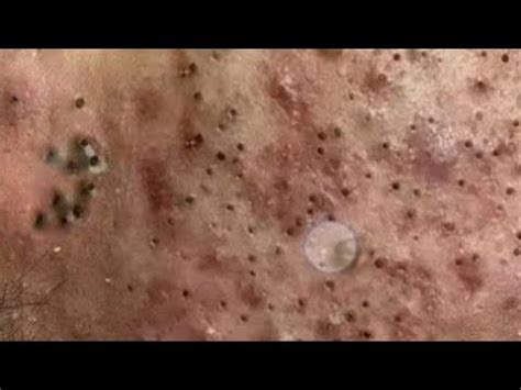 Image result for Large Pimples Exploding