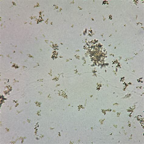 Granular Casts: Identification & Significance - MedLabBuddy