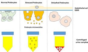 Urinary sediment messenger RNA potent biomarker of IgA nephropathy ...