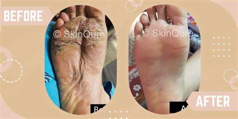 Eczema Treatment in Delhi, Saket at SkinQure