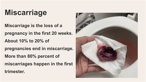 Percentage Of Miscarriage By Week