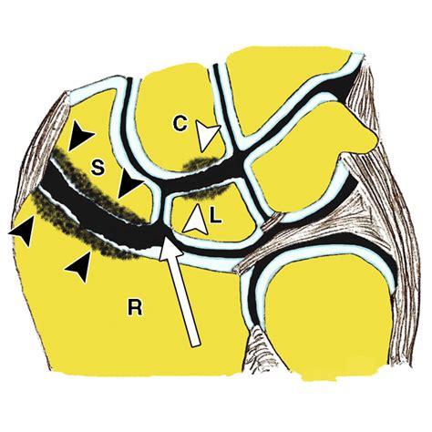 Scapholunate Advanced Collapse and Scaphoid Nonunion Advanced Collapse: MDCT Arthrography ...