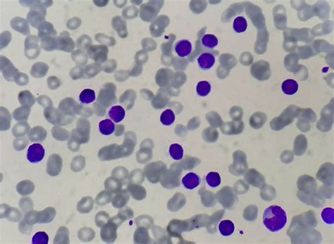Chronic Lymphocytic Leukemia/ Small Lymphocytic Lymphoma - howitreat.in