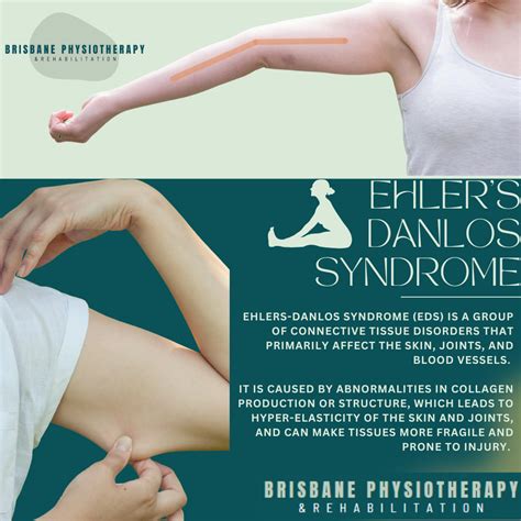 Ehlers-Danlos Syndrome and How a Physiotherapist Can Help - Brisbane ...