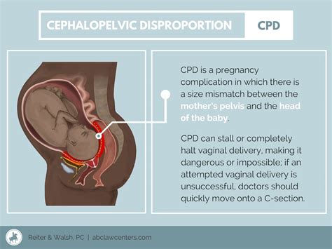 Cephalopelvic Disproportion (CPD) Injuries - ABC Law Centers