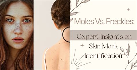 Moles Vs. Freckles: Expert Insights on Skin Mark Identification ...
