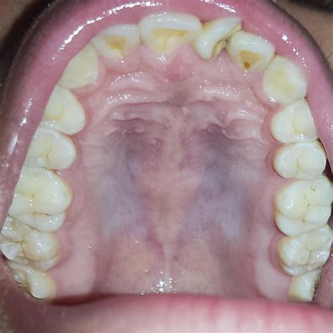White on roof of mouth : r/askdentists