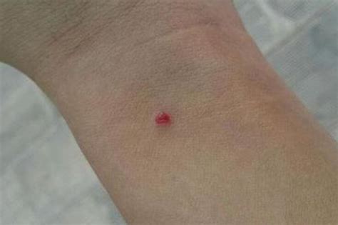 慢性肝病患者皮肤有红点，是蜘蛛痣吗?做下这动作就知道了