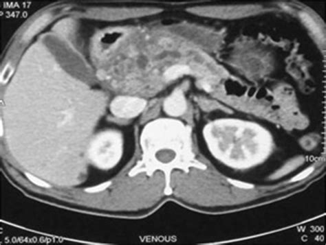 Pancreatitis: Symptoms, Causes, Diagnosis & Treatments | Dr. Prasad K Wagle