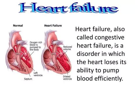 Image result for Heart Failer Compensatory Processes
