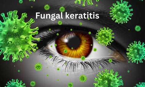 Therapeutic Penetrating Keratoplasty an effective treatment option for ...