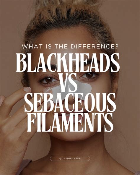 Illume Skin & Laser YYC | ⚫️BLACKHEADS VS SEBACEOUS FILAMENTS⚫️ SWIPE for more! Do you sit in ...