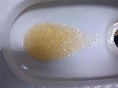 小便有泡泡或混浊就是肾不好? 医生教你十分钟辨识蛋白尿!