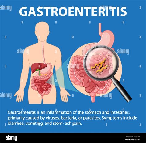 Salmonella Gastroenteritis Symptoms In Adults at Melissa Eide blog