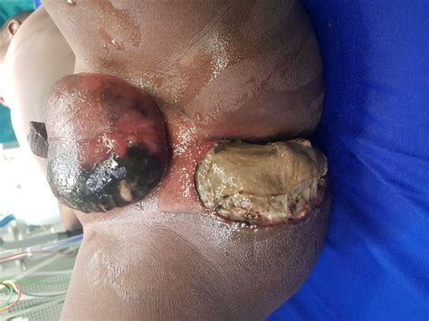 Reconstruction of the Perineum after Fournier Gangrene in a Child: A Case Report