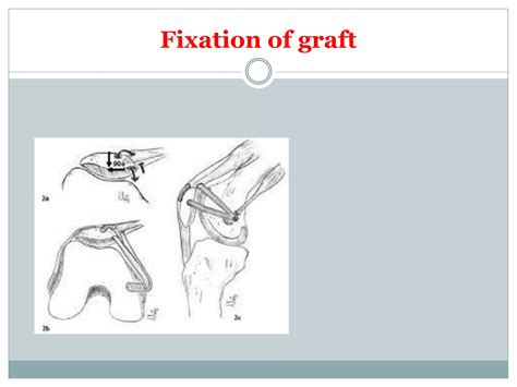 Medial patellofemoral ligament (MPFL) reconstruction | PPTX