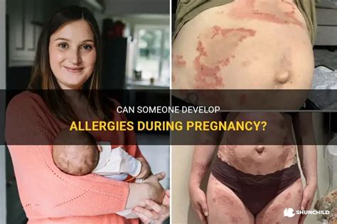 Can Someone Develop Allergies During Pregnancy? | ShunChild