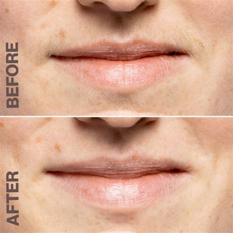 How to Use DermaFlash 的图像结果