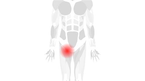 Understanding Sports Hernia: Causes, Symptoms, and Treatment