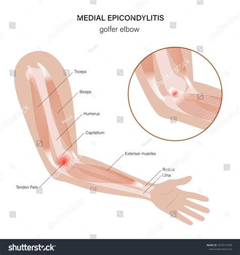 Medial Epicondyle Of The Humerus