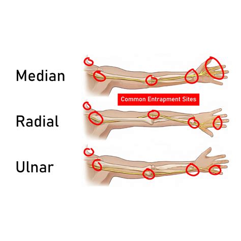 How To Fix Ulnar Nerve Entrapment | Causes & Symptoms | Gymless