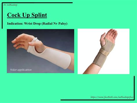 Orthopedic Splints and Casts- Subhadeep PGModules.pptx