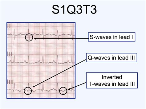 Pulmonary Embolism Ecg